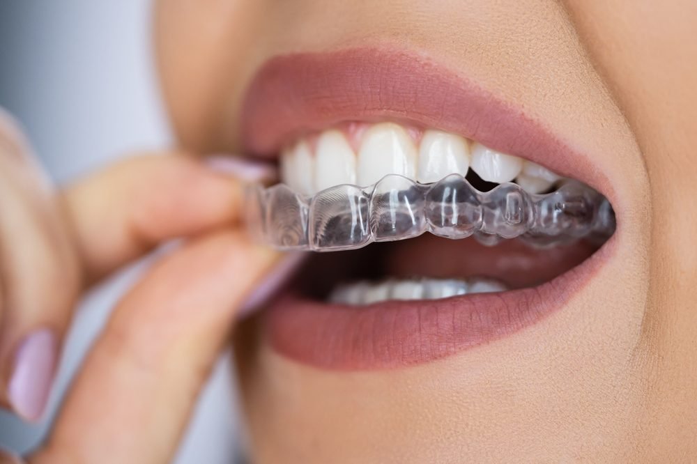 Clear Aligners at Shree Lalithaa Dental Care Mettupalayam