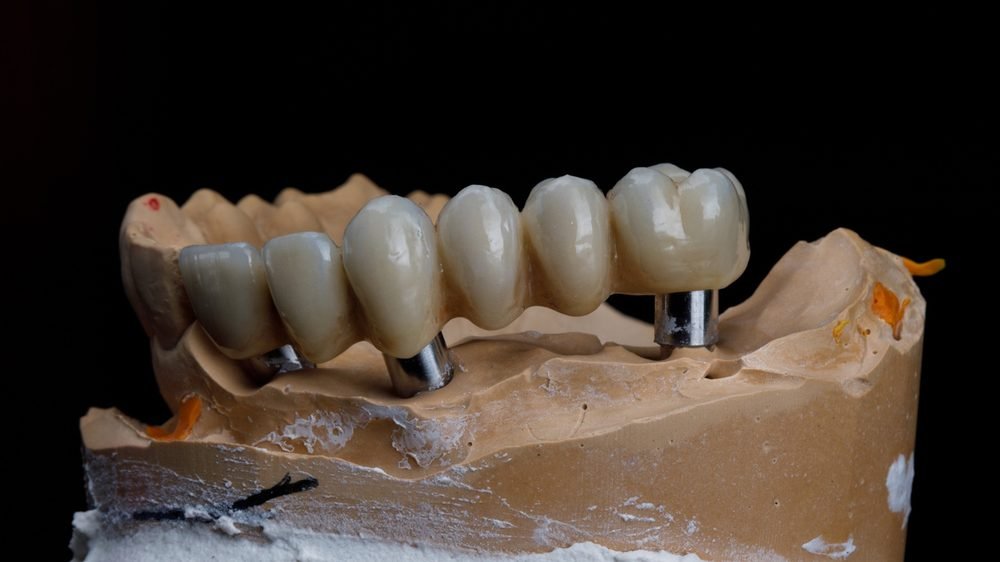 Crowns & Bridges at Shree Lalithaa Dental Care Mettupalayam