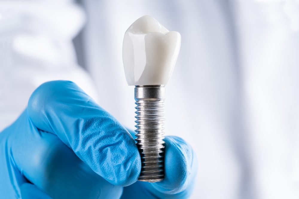 Dental Implants at Shree Lalithaa Dental Care Mettupalayam