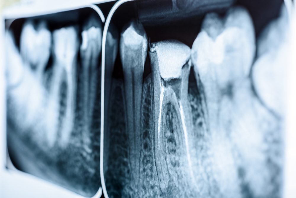 Root Canal Treatment at Shree Lalithaa Dental Care Mettupalayam